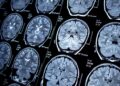 Early Signs Of Neurological Disorders You Shouldn’t Ignore: Crucial Indicators and Their Impact