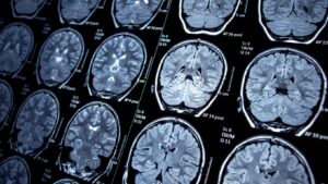 Early Signs Of Neurological Disorders You Shouldn’t Ignore: Crucial Indicators and Their Impact