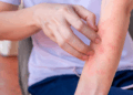 Understanding Housewife Eczema and Its Impact on Daily Life