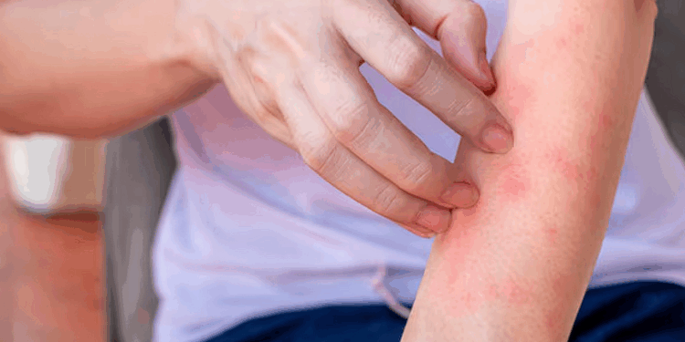 Understanding Housewife Eczema and Its Impact on Daily Life