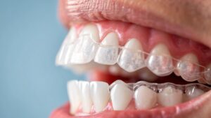 Your Guide to Modern Orthodontic Options for a Confident Smile