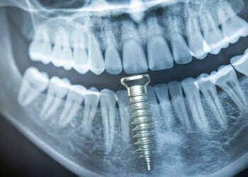 How Pterygoid Implants Work and Benefits Over Traditional Implants Explained Clearly