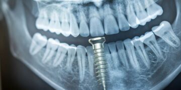 How Pterygoid Implants Work and Benefits Over Traditional Implants Explained Clearly