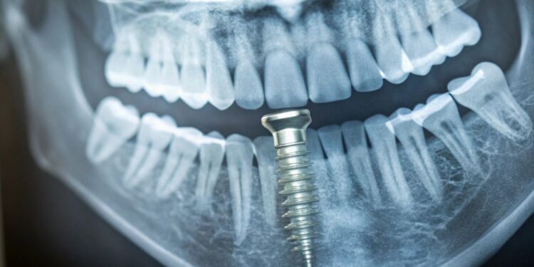 How Pterygoid Implants Work and Benefits Over Traditional Implants Explained Clearly