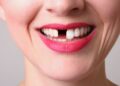 How Missing Teeth Affect Confidence and Social Life Impacting Personal and Professional Relationships