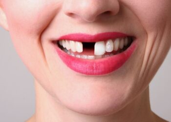 How Missing Teeth Affect Confidence and Social Life Impacting Personal and Professional Relationships