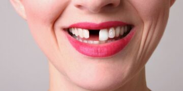 How Missing Teeth Affect Confidence and Social Life Impacting Personal and Professional Relationships