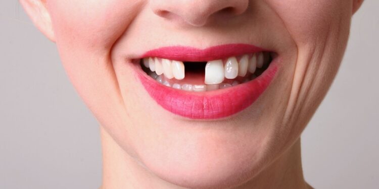 How Missing Teeth Affect Confidence and Social Life Impacting Personal and Professional Relationships