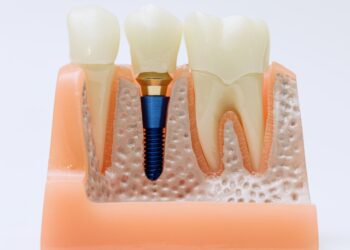 Bone Grafting for Dental Implants: Why Jawbone Health Matters — Ensuring Stable, Long‑Lasting Implant Success