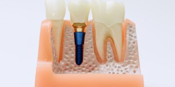 Bone Grafting for Dental Implants: Why Jawbone Health Matters — Ensuring Stable, Long‑Lasting Implant Success
