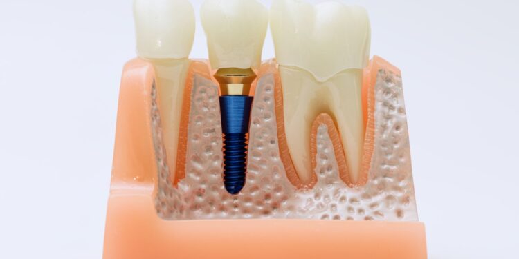 Bone Grafting for Dental Implants: Why Jawbone Health Matters — Ensuring Stable, Long‑Lasting Implant Success