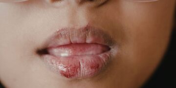 Why Choose Online Care for Canker Sores?