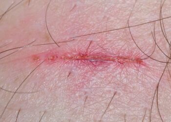 Biofilm Formation in Wounds: The Hidden Barrier to Healing