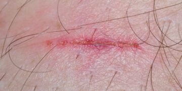 Biofilm Formation in Wounds: The Hidden Barrier to Healing