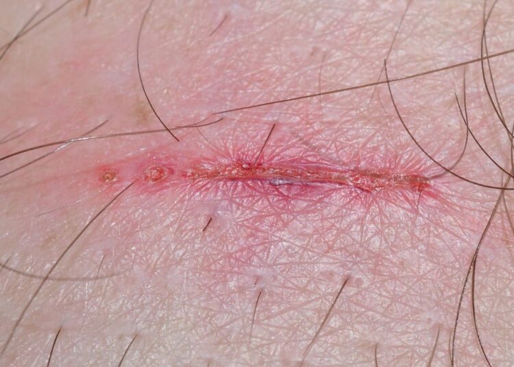 Biofilm Formation in Wounds: The Hidden Barrier to Healing