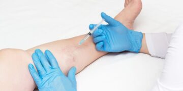 Non-Surgical Treatments for Vein Disease: What Patients Should Know