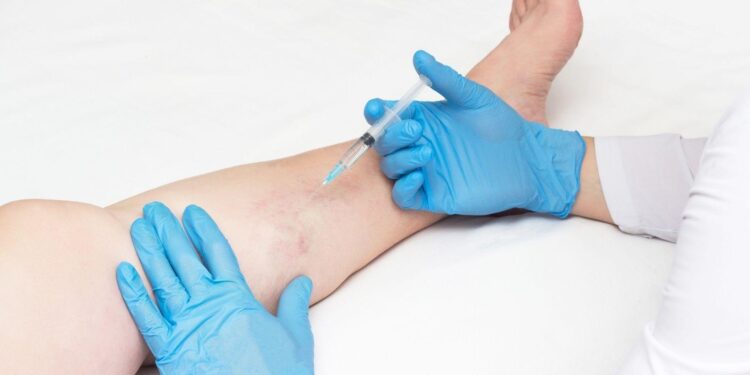 Non-Surgical Treatments for Vein Disease: What Patients Should Know