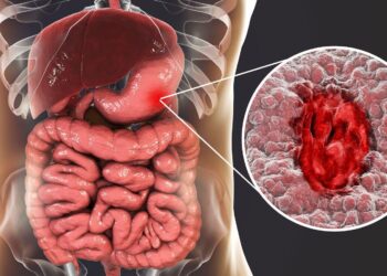 From Biomarkers to Immunotherapy: What’s Next in Gastric Cancer Care