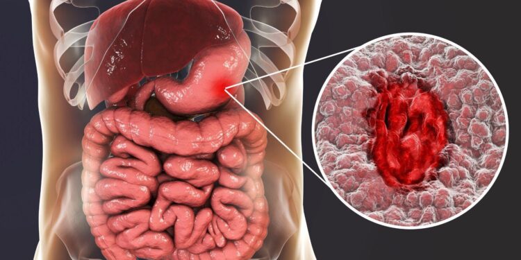 From Biomarkers to Immunotherapy: What’s Next in Gastric Cancer Care