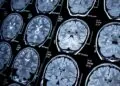 Early Signs Of Neurological Disorders You Shouldn’t Ignore: Crucial Indicators and Their Impact